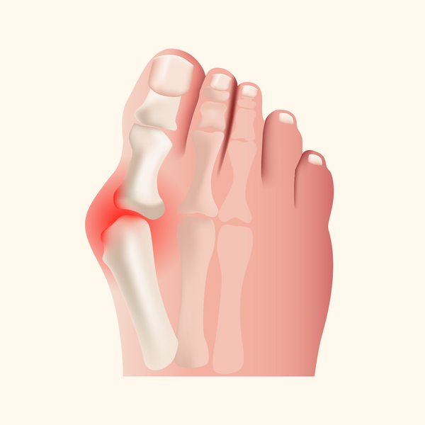 Bunions