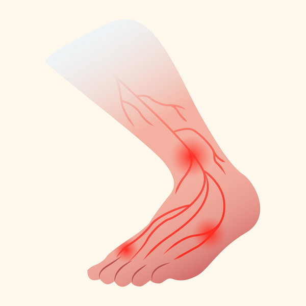 Diabetes &amp; Neuropathy