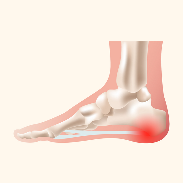 Plantar Fasciitis